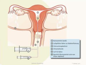 Kinderwunsch – Gebärmutterspiegelung (Hysteroskopie)