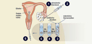 Kinderwunsch – Behandlungsmethode In vitro Fertilisation (IVF)
